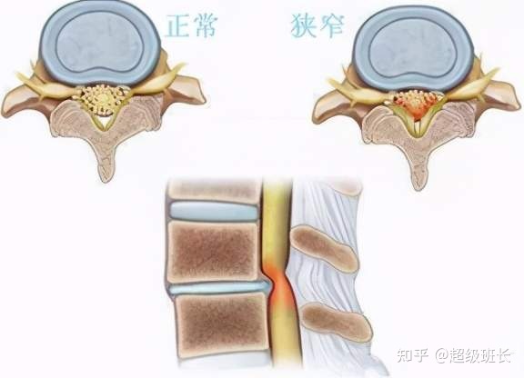 腰椎管狭窄手术成功率高吗？都是怎样做的？