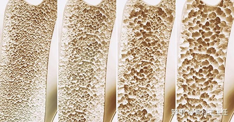 如何判断骨质疏松症的严重程度？