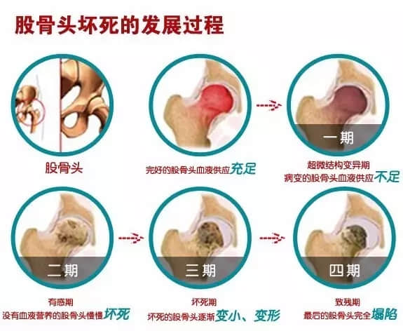 股骨头坏死会造成患者哪里疼痛