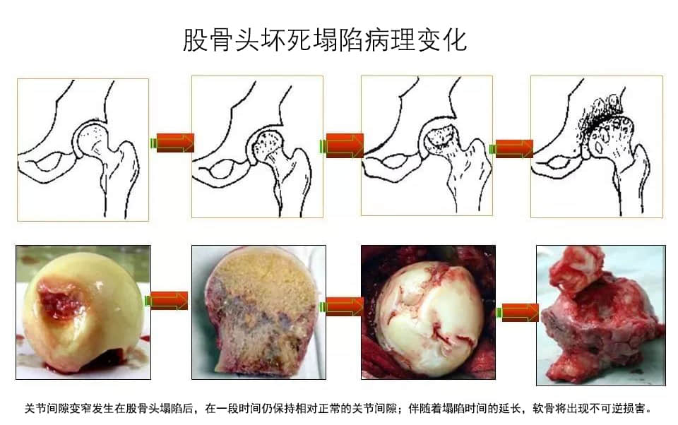 股骨头缺血坏死病理演变过程