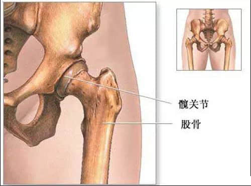 莲池骨科医院-股骨头坏死患者，哪些情况下要做置换手术了？