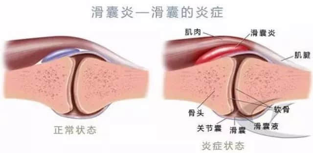 莲池骨科医院 滑囊炎