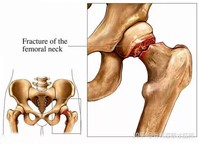 股骨颈骨折为什么被称为“人生最后一次骨折”