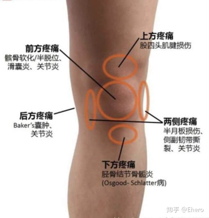 膝盖积液是怎么回事?如何预防或消除