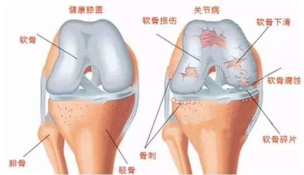 关节软骨到底指什么？