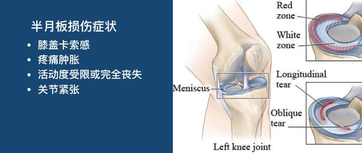 如何分辨半月板损伤还是韧带损伤？